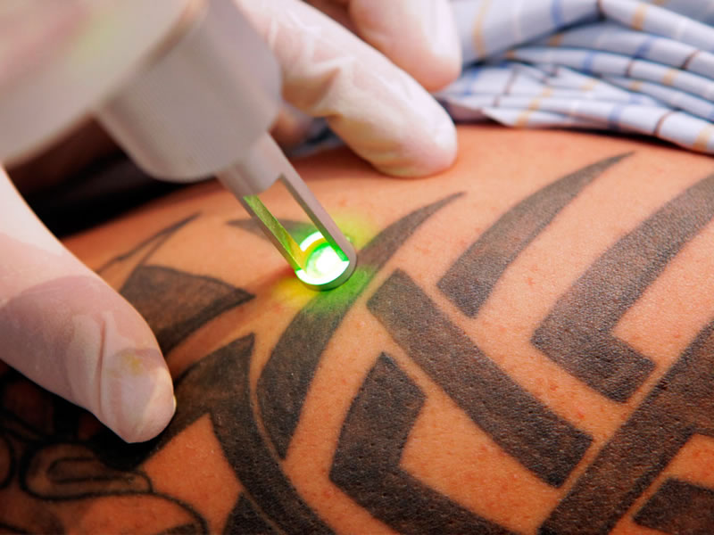 borrado de tatuajes