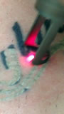 Borrado de tatuajes